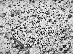 M, 3y. | suprarenal neuroblastoma M, 3y. | suprarenal neuroblastoma